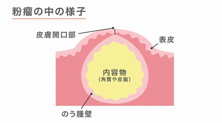 粉瘤の手術