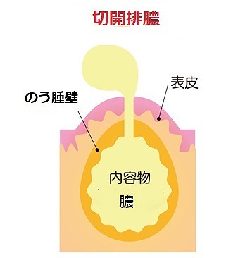 炎症期の粉瘤の治療法