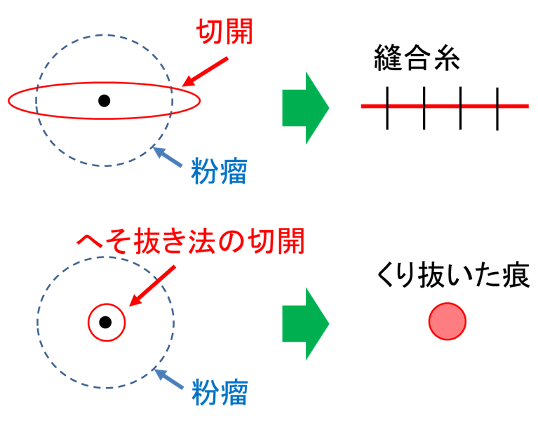 へそ抜き法手術